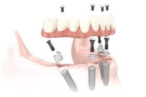 All on 4 Implants Antalya Turkey