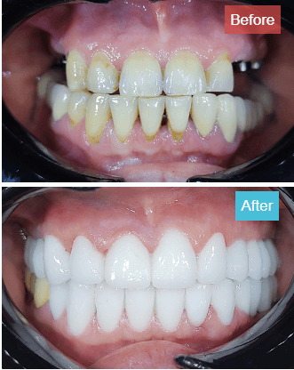 Tooth Bleaching in Antalya Turkey