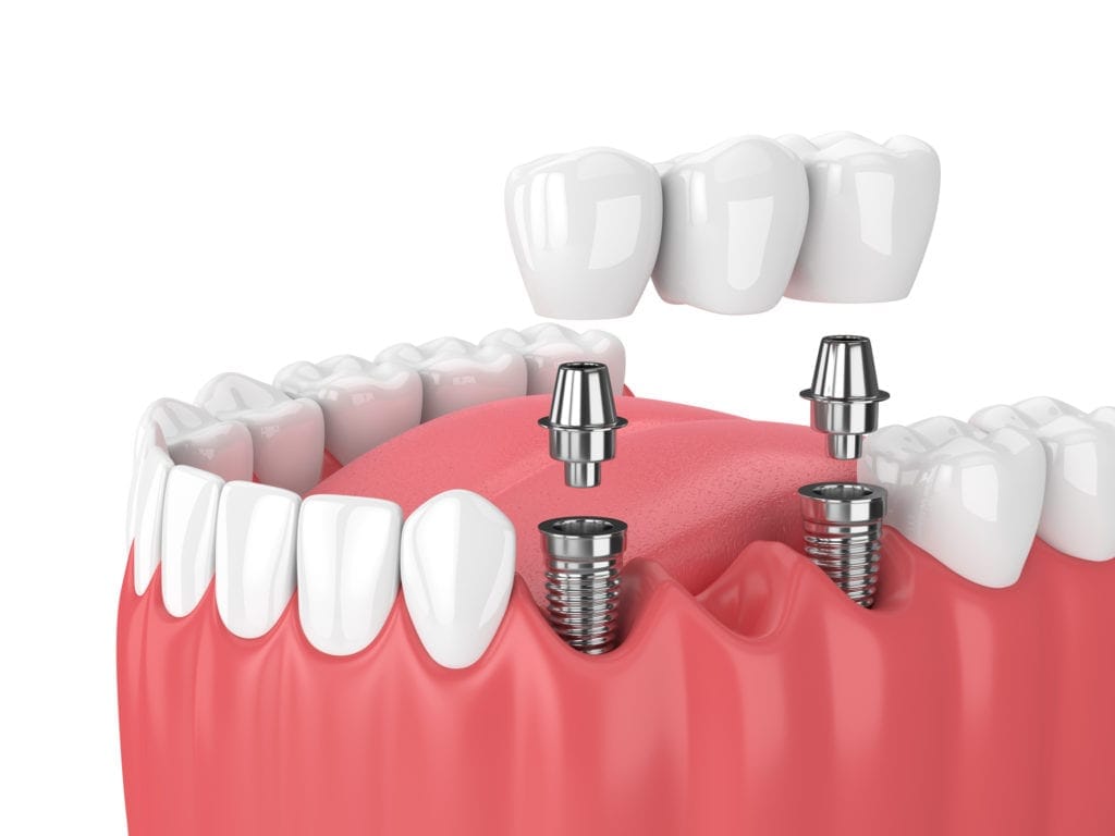 Dental Bridge in Antalya Turkey