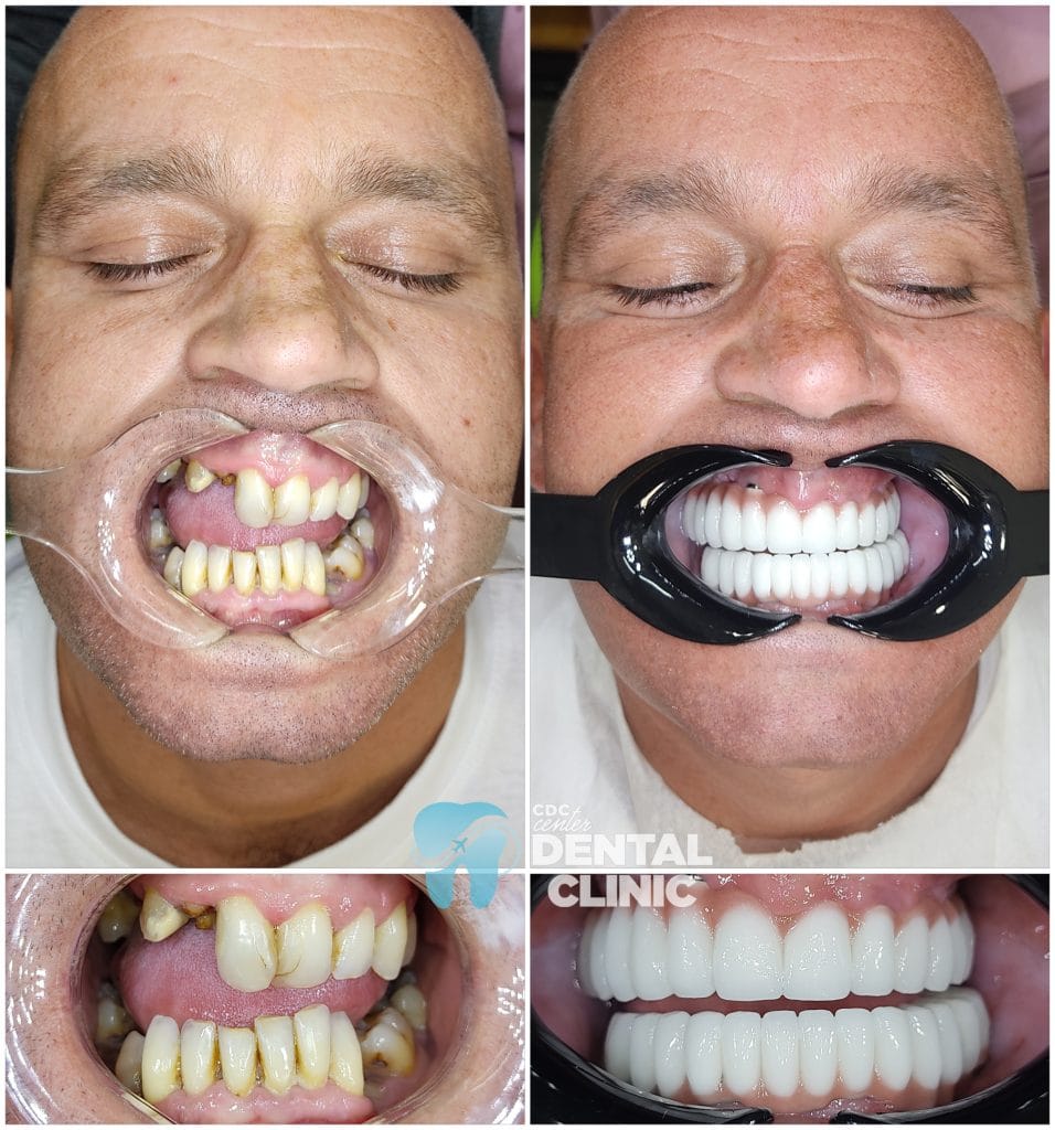 All on 6 and Zirconium Crowns