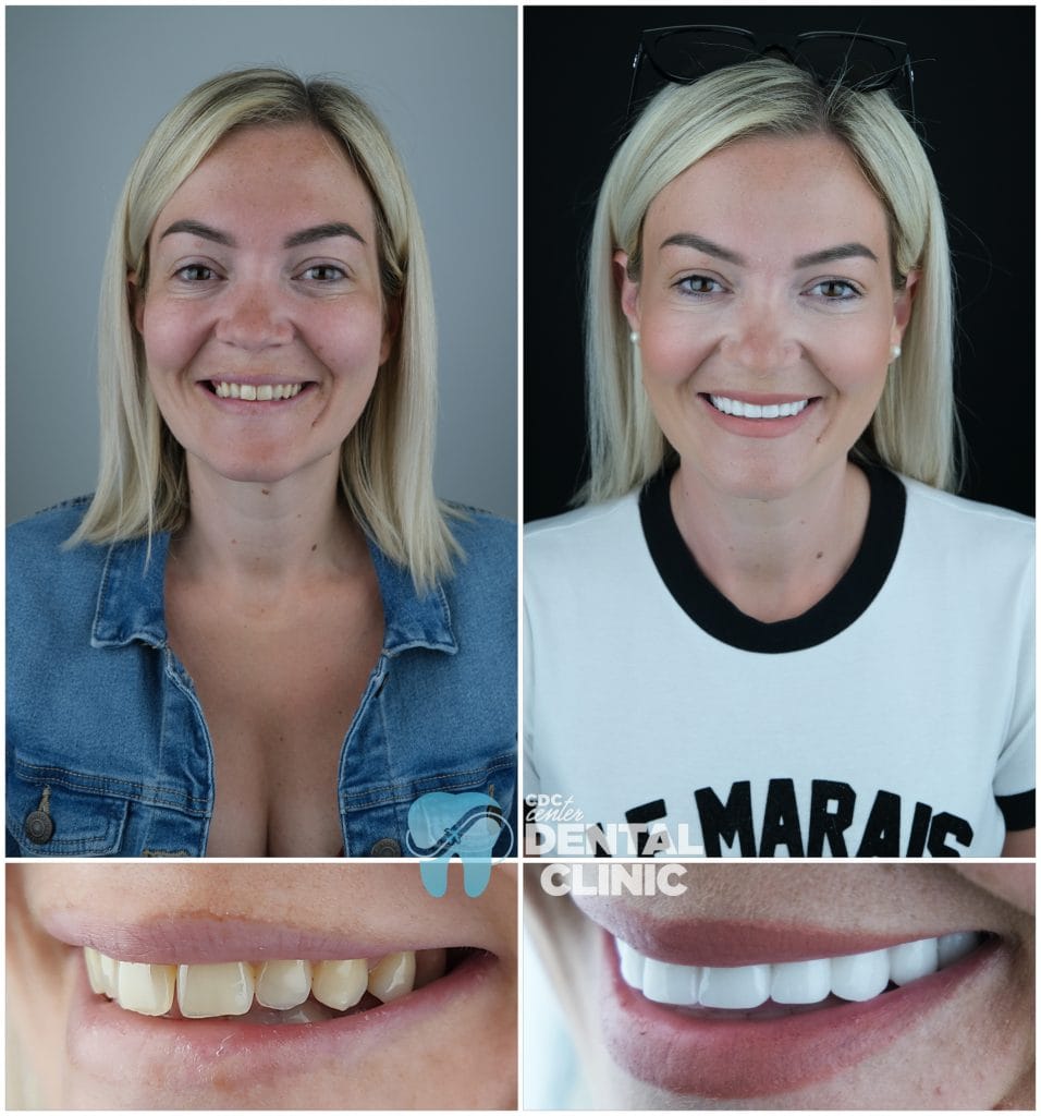 Zirconium Crowns