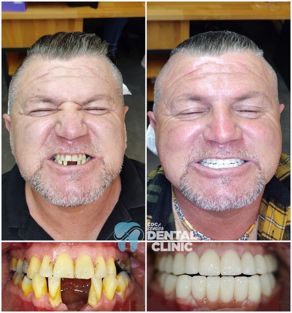 Dental Implants and Zirconium Crowns