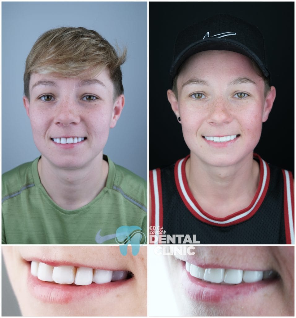Zirconium Crowns