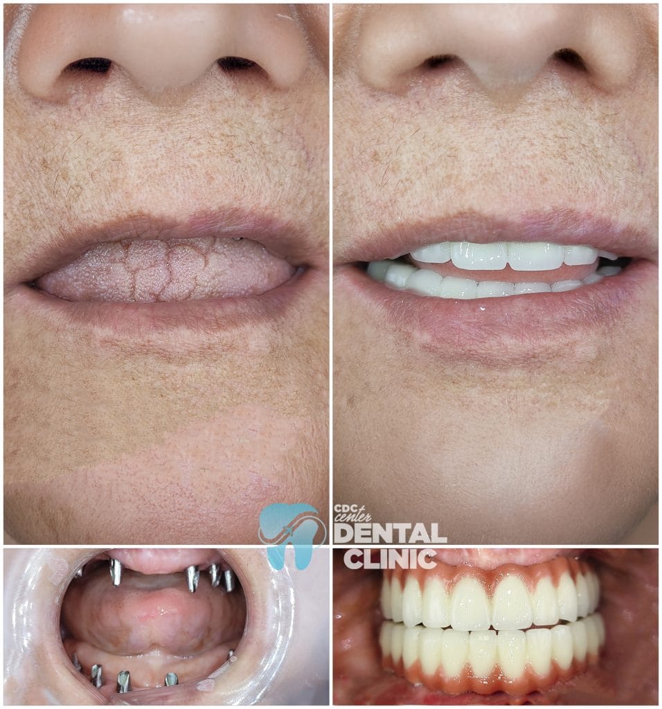 All on 6 and Zirconium Crowns