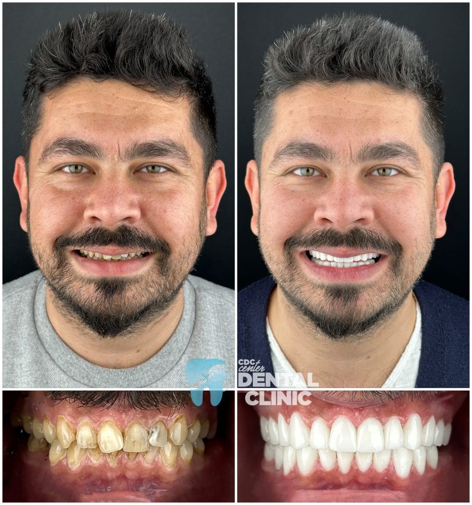 Zirconium Crowns