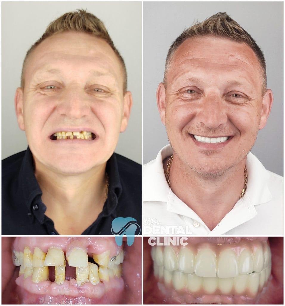 All on 6 and Zirconium Crowns