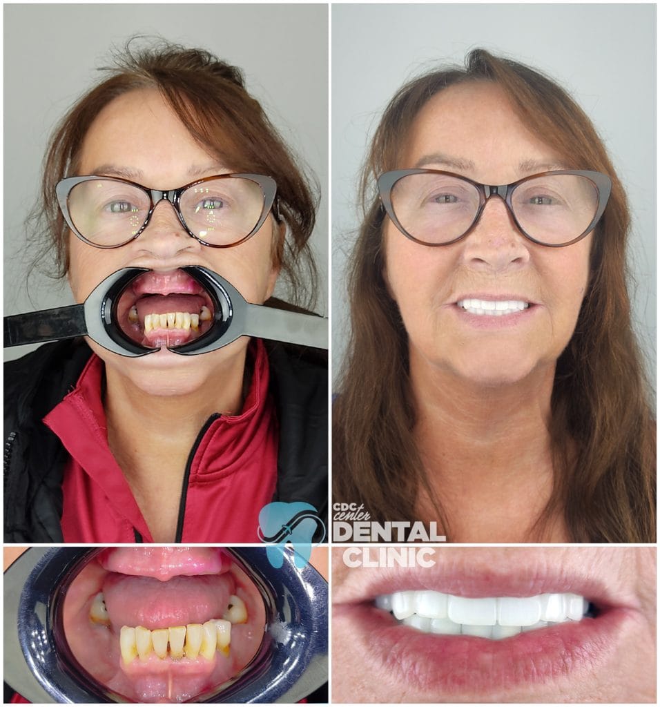 All on 6 and Zirconium Crowns