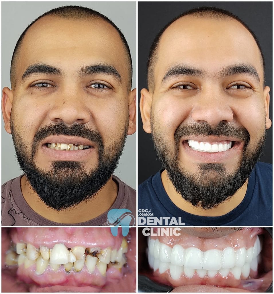 Zirconium Dental Crowns in Antalya
