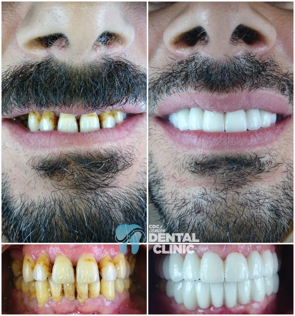 Zirconium Crowns