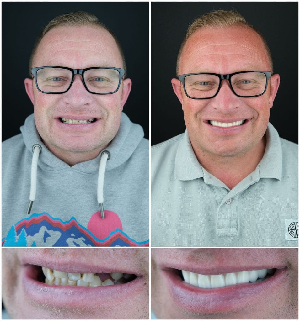 All on 6 and Zirconium Crowns