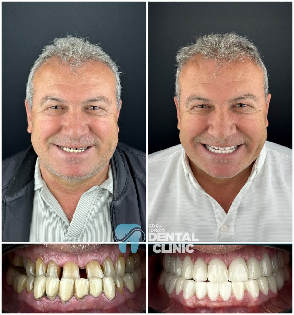 Zirconium Crowns