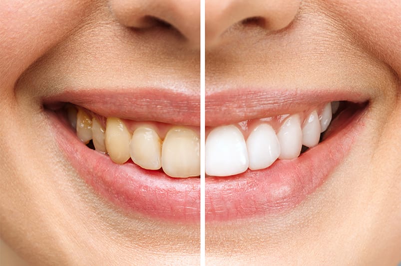 tooth bleaching in Antalya turkey