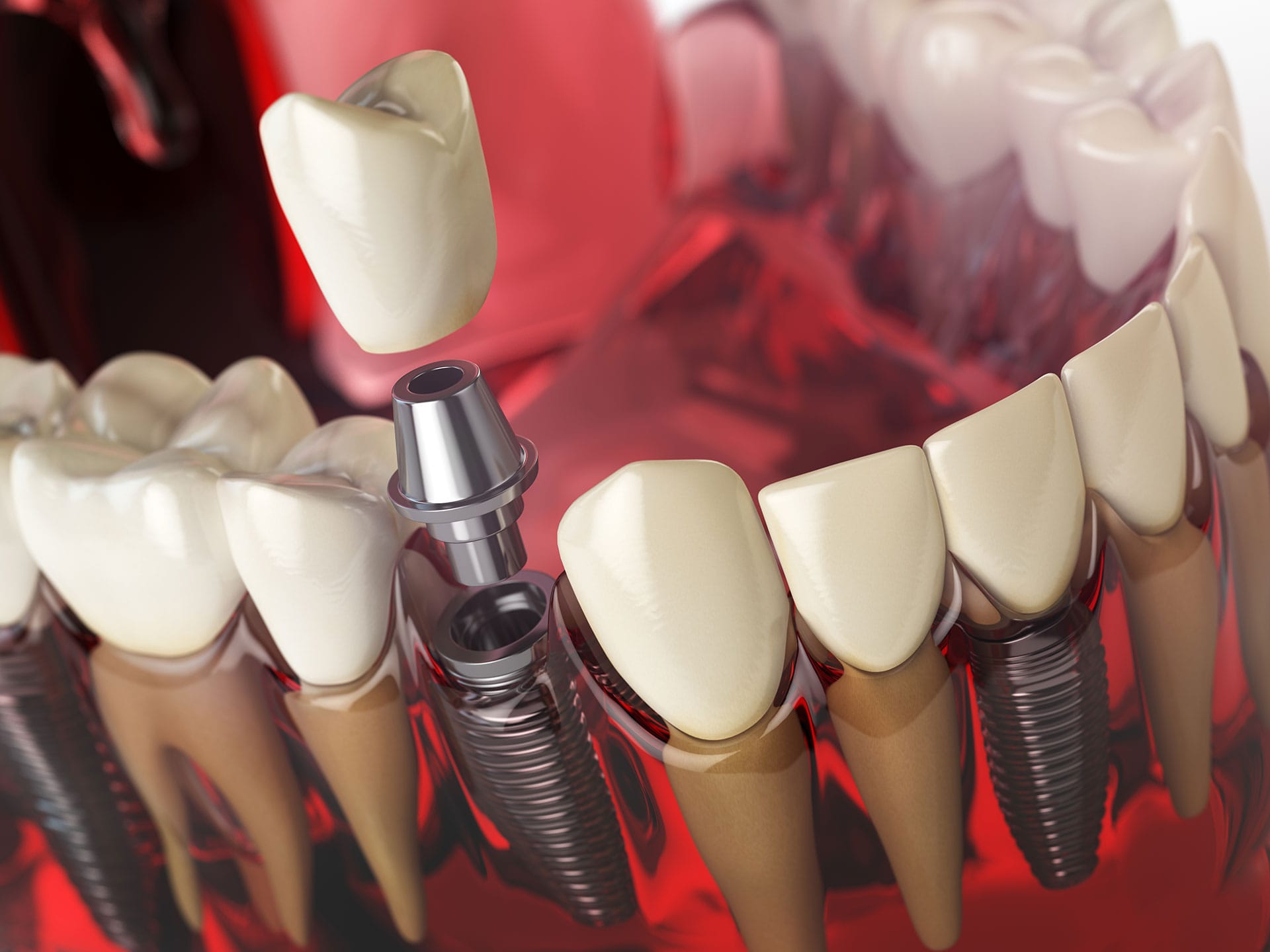 Why Choose an Antalya Dental Clinic for Dental Implants Turkey?