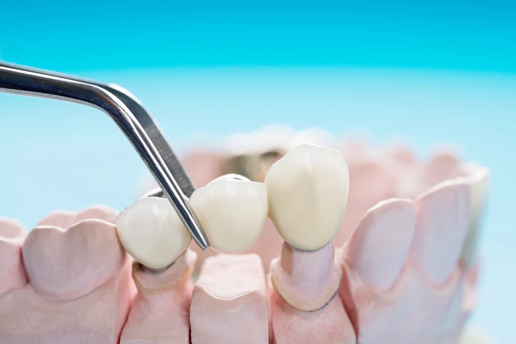 Dental Filling in Antalya