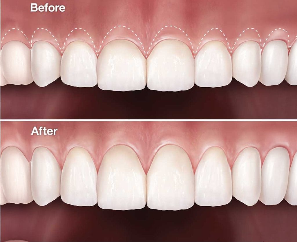 Aesthetic Gum Treatment in Antalya Turkey