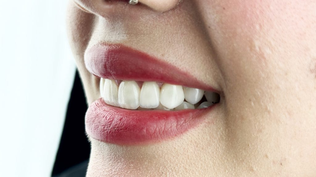 Hollywood Smile in Antalya Turkey