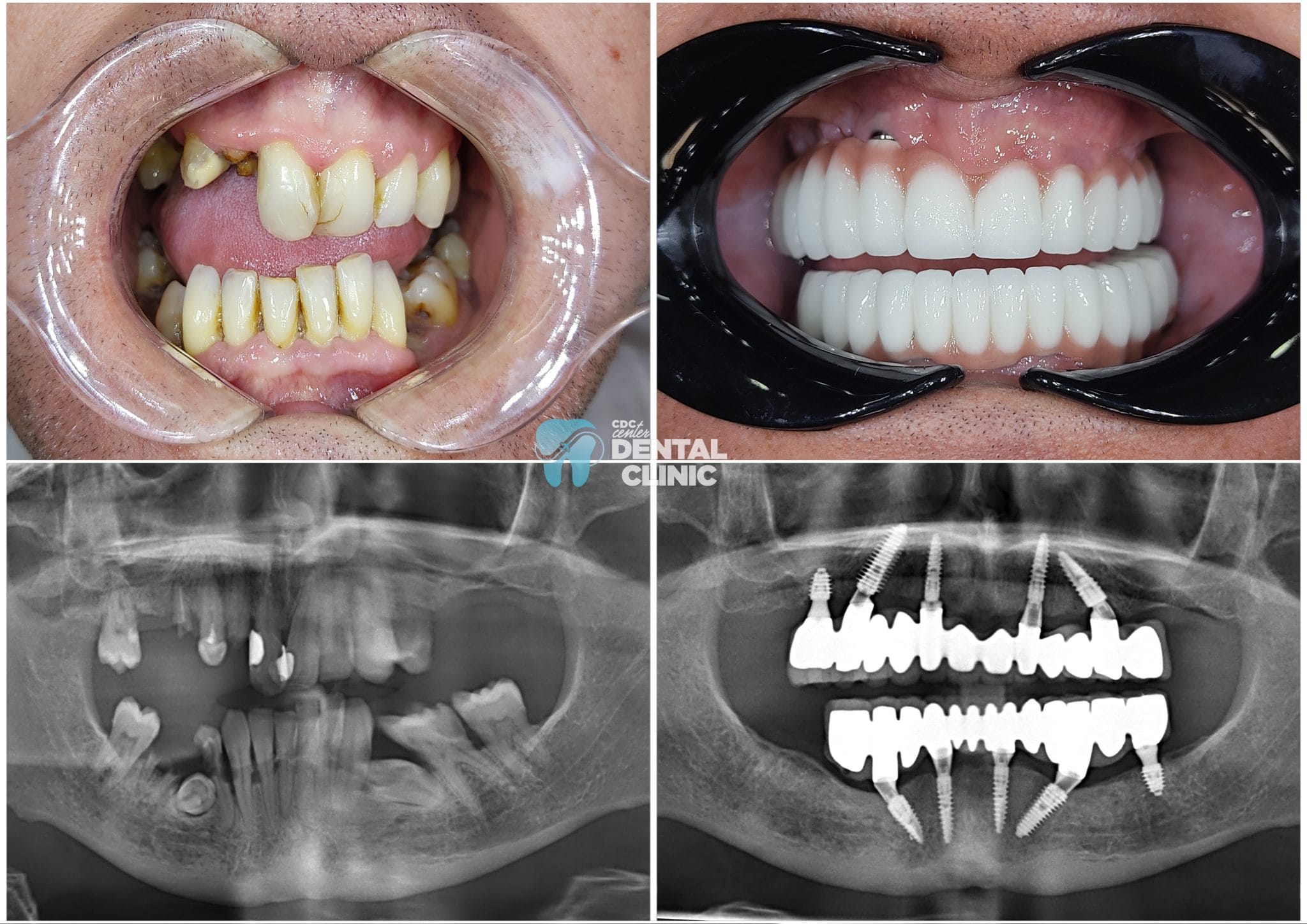 All on Six in Antalya Turkey | All On 4-6 implants
