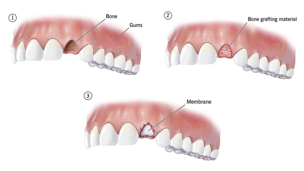 Bone Grafting dental in Antalya turkey