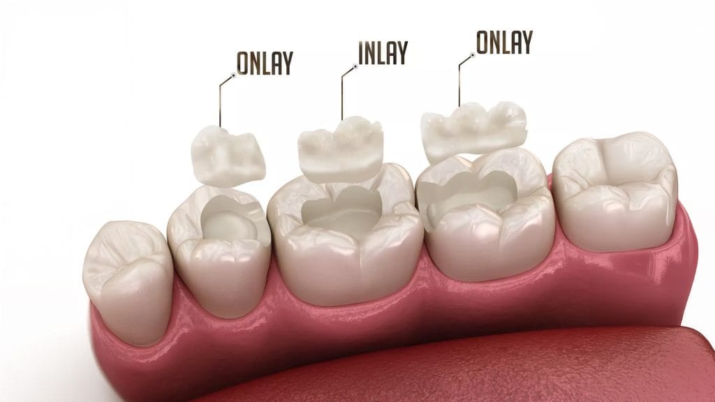 Inlay and Onlay Restorations in Antalya turkey