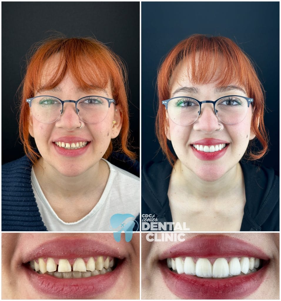 Dental Veneers in antalya turkey