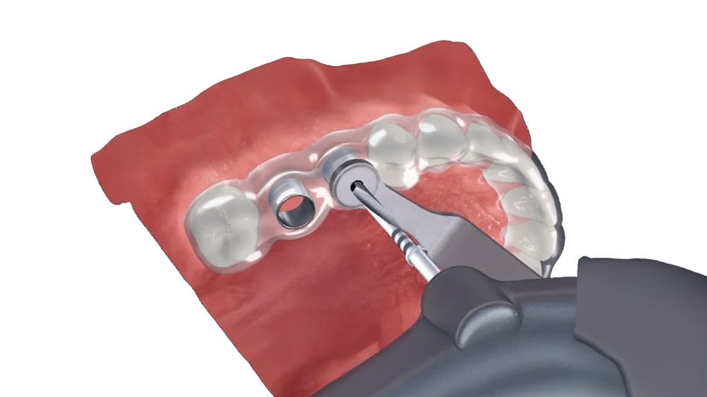 Non Surgical Dental Implant in antalya turkey