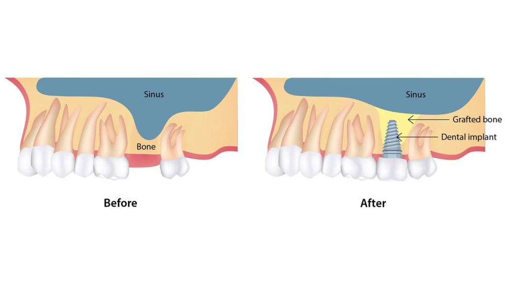 Sinus Lifting dental in Antalya Turkey