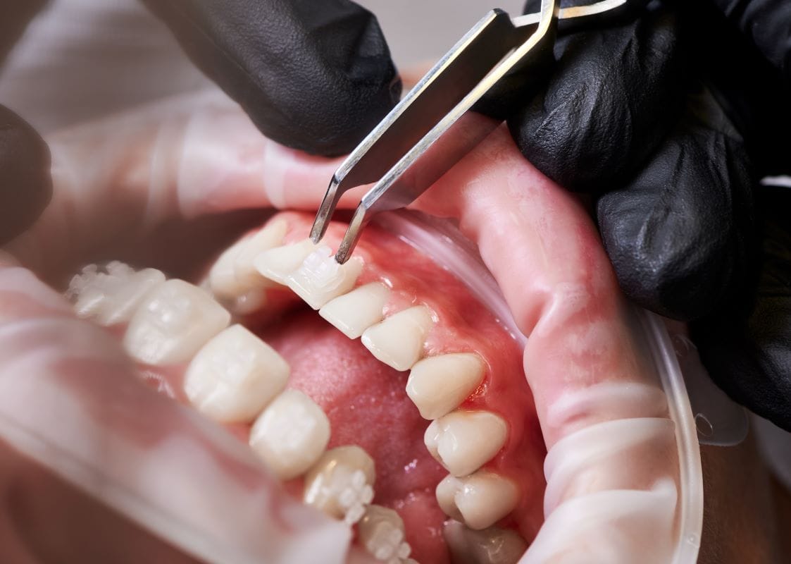 Top Clinics for Gum Disease in Antalya Revealed