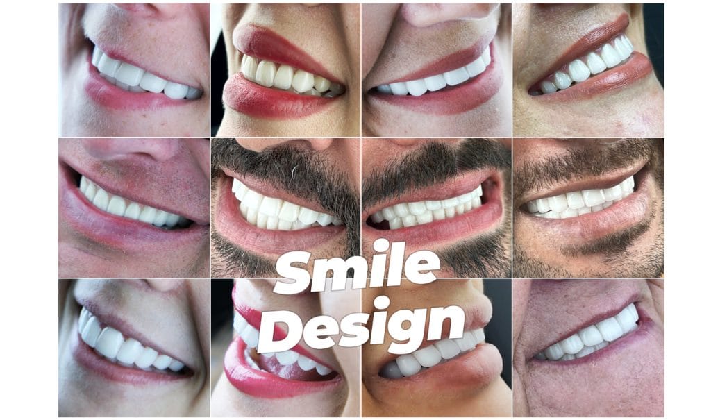 Smile Design in Antalya Turkey