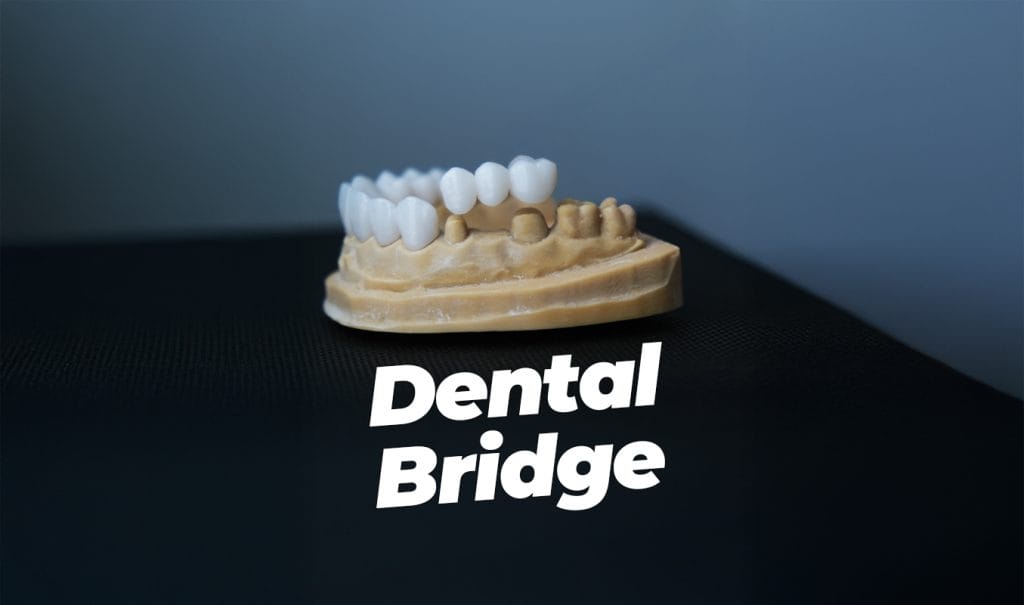 Dental Bridge in Antalya Turkey
