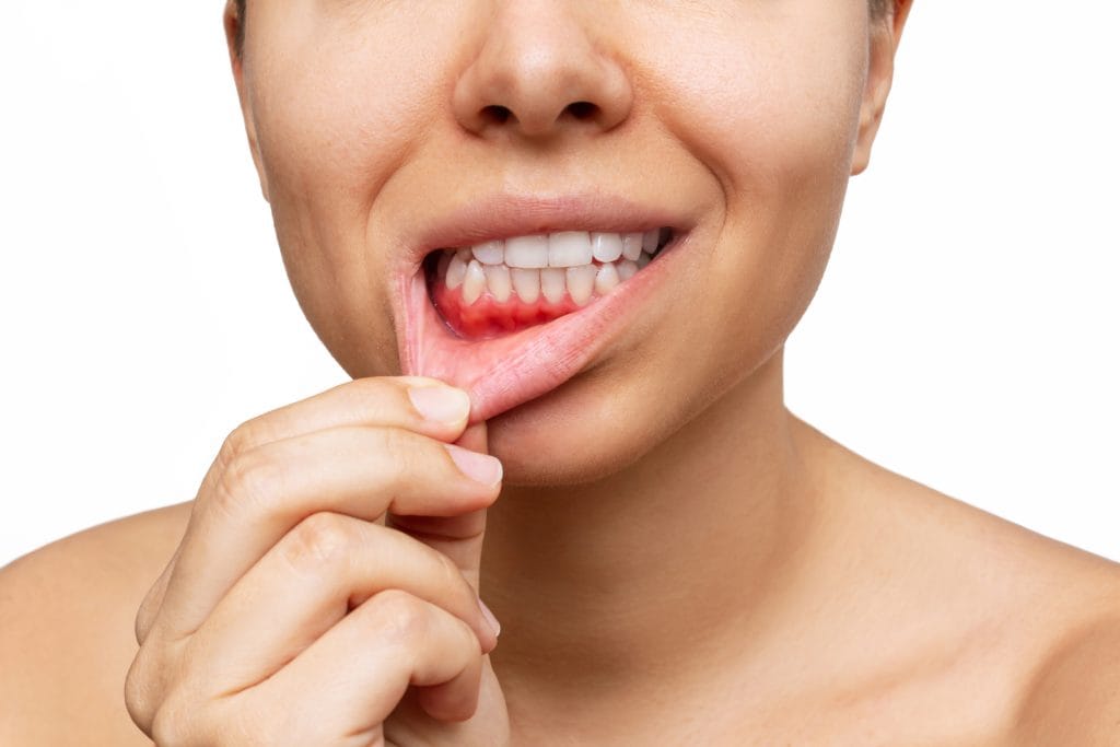 Gum Disease Treatment dental clinic - Antalya Turkey