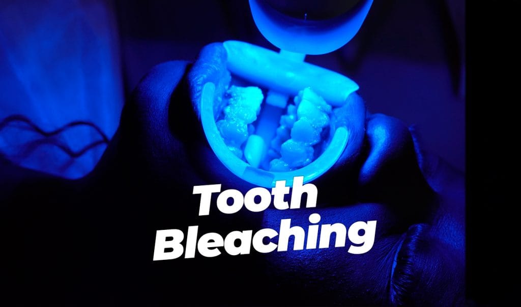 tooth bleaching in antalya turkey