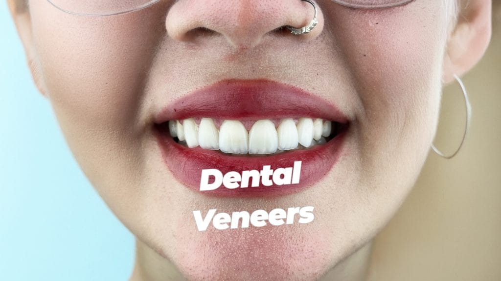 Laminate Teeth Veneers in Turkey: Why They’re Worth It