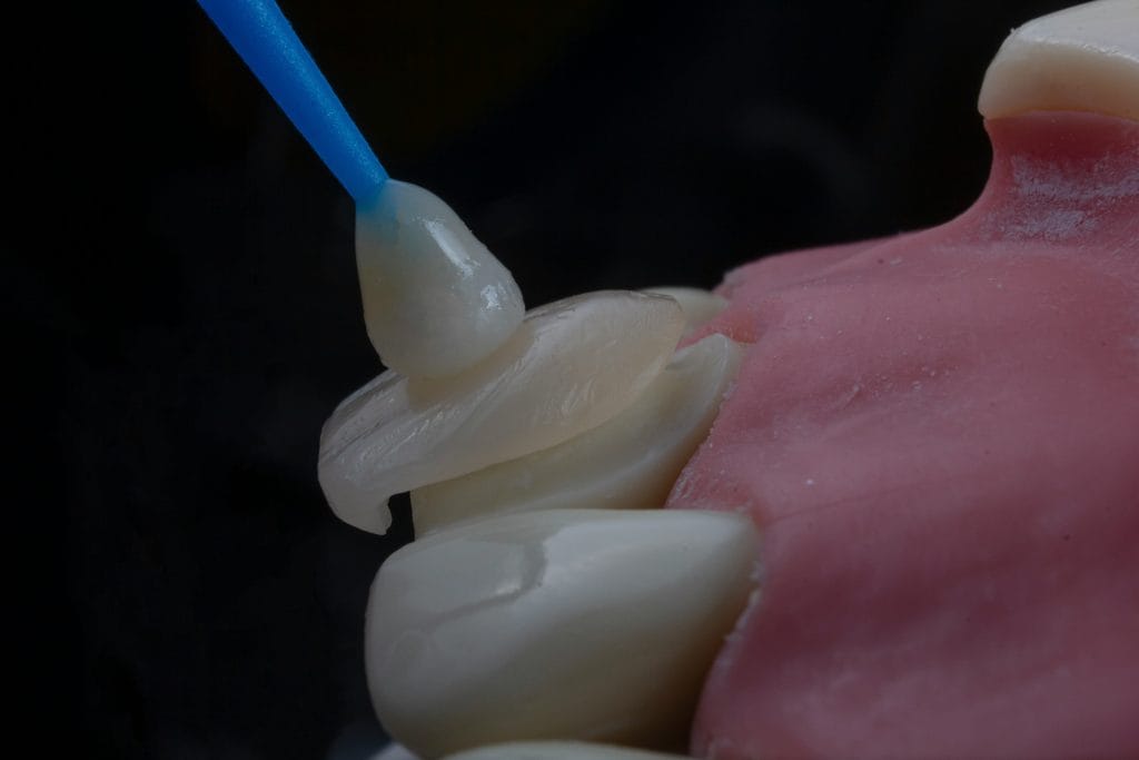 dental implant procedure