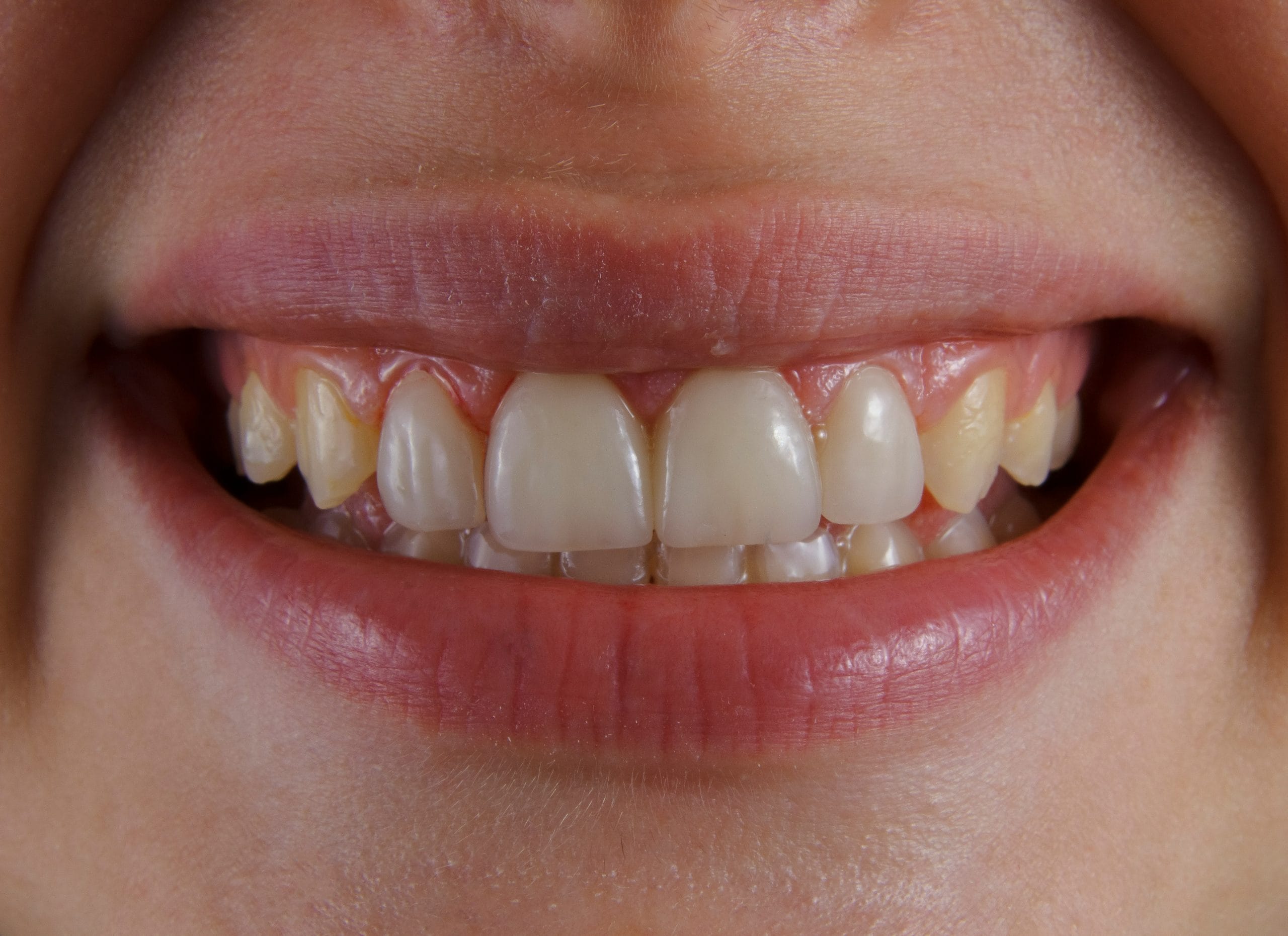 Expert Antalya Teeth Whitening: Your Guide to Top Clinics
