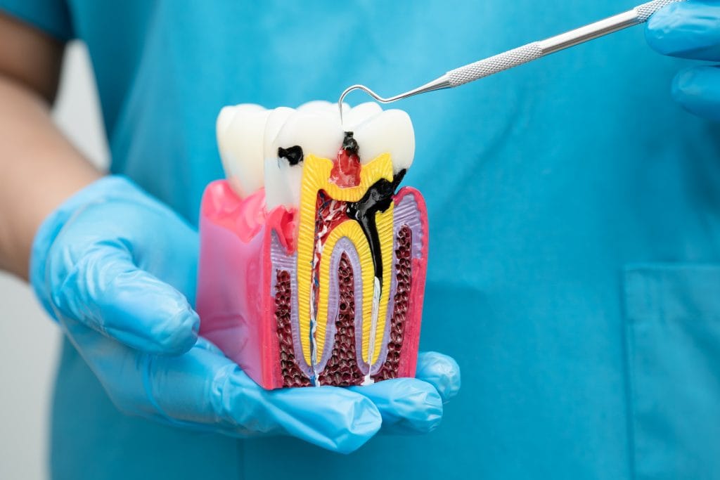 Dental Root Canal Treatment in antalya turkey