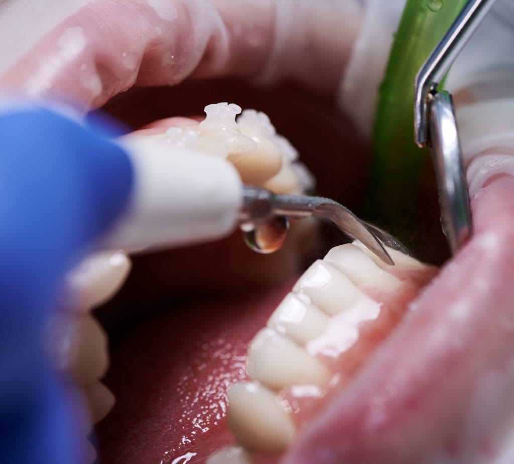 gum disease treatment in Antalya turkey