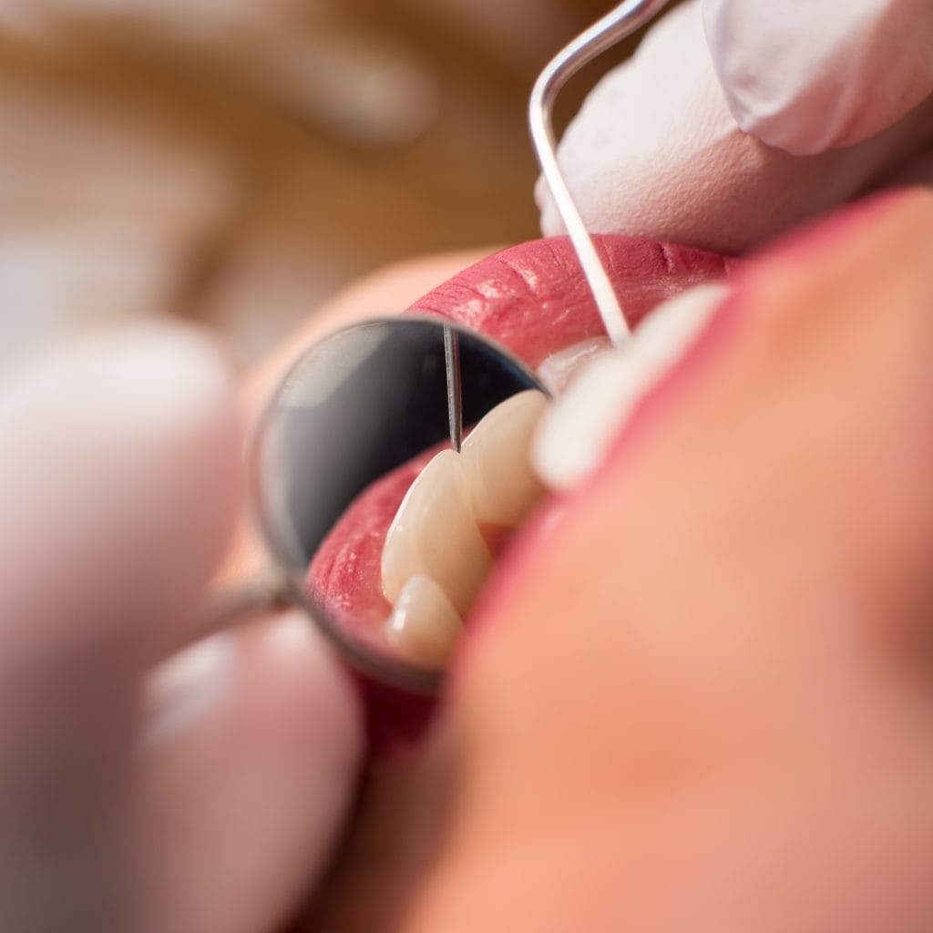 Dental Fillings in antalya turkey