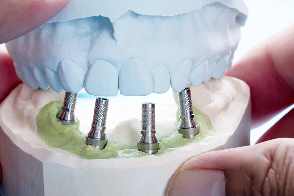 Comprehensive Insights into All on 4 Dental Implants Turkey