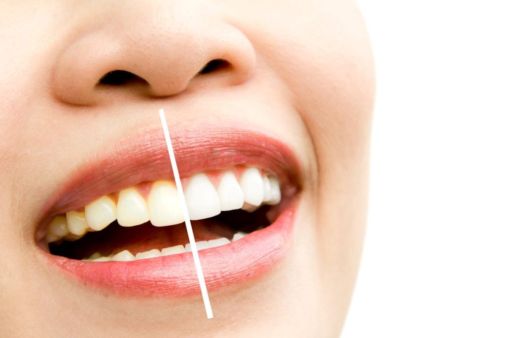 Antalya Teeth Whitening