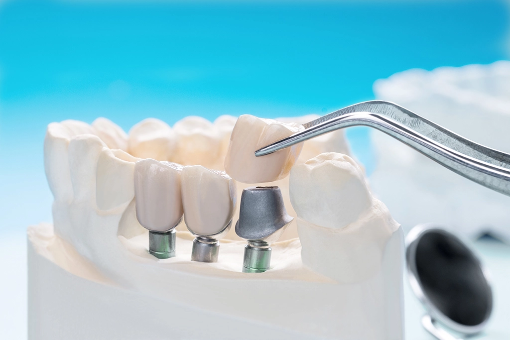 dental Implants abroad helvetic clinics