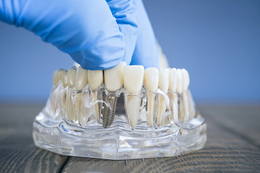 Why Choosing Dental Implants Abroad Helvetic Clinics Is Your Best Investment in Smile Restoration