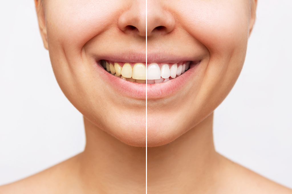Exploring Teeth Whitening Options in Turkey